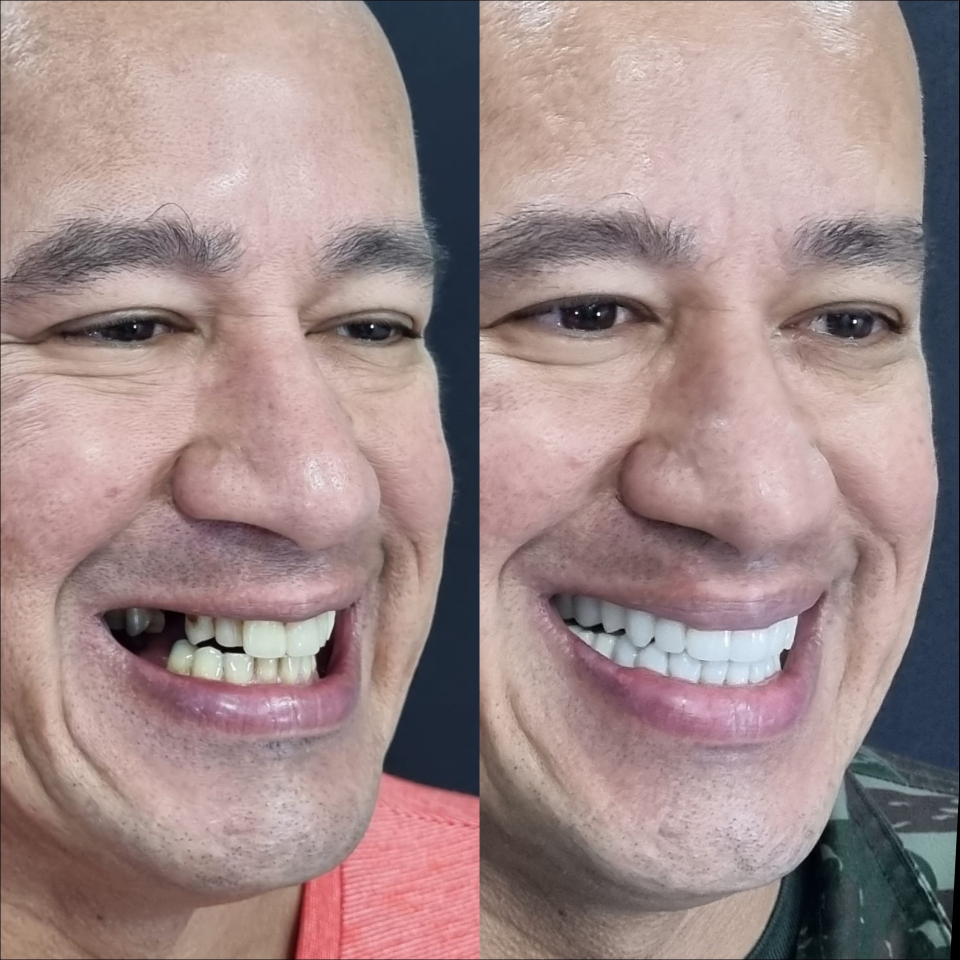Antes e depois — reabilitação com lentes