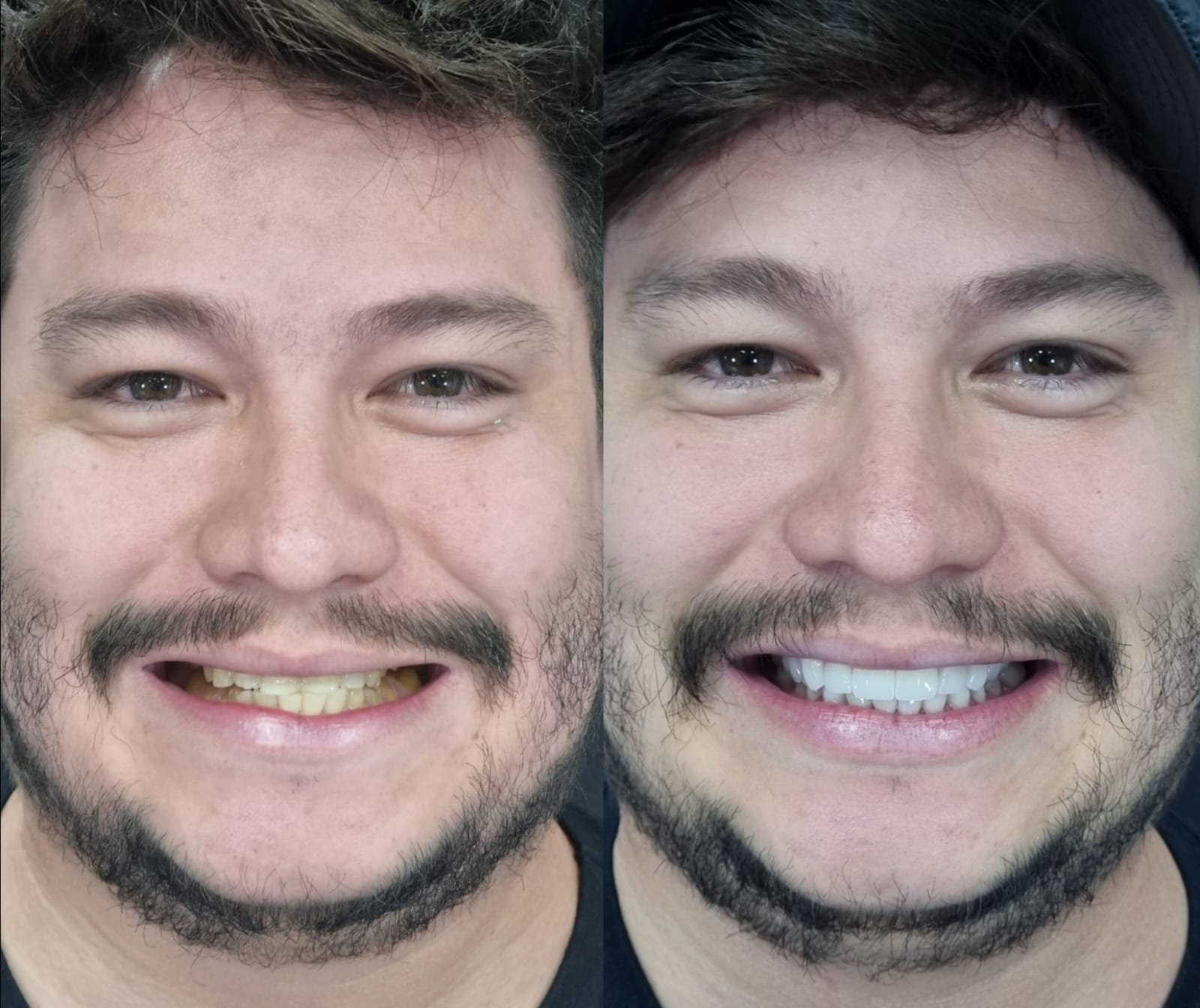 Antes e depois — clareamento e lentes