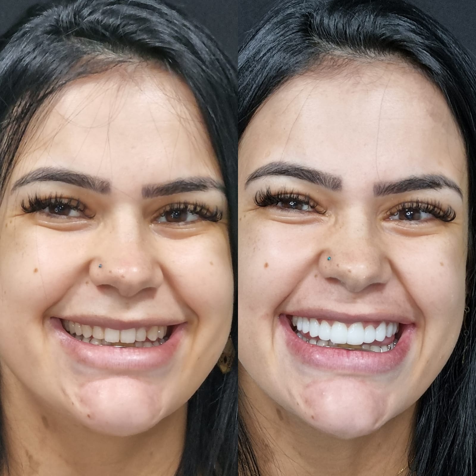 Antes e depois — reabilitação estética