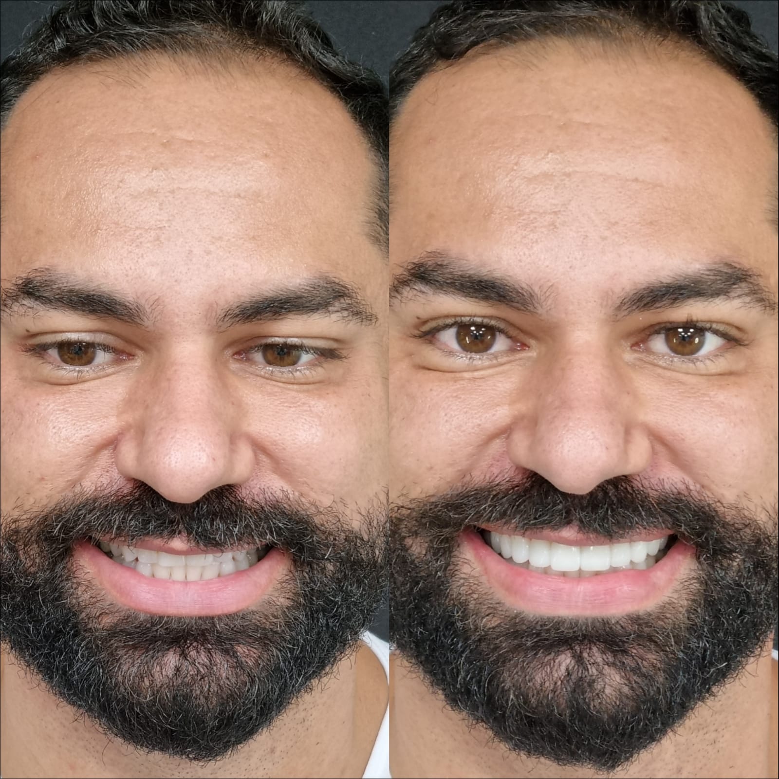 Antes e depois — lentes em resina