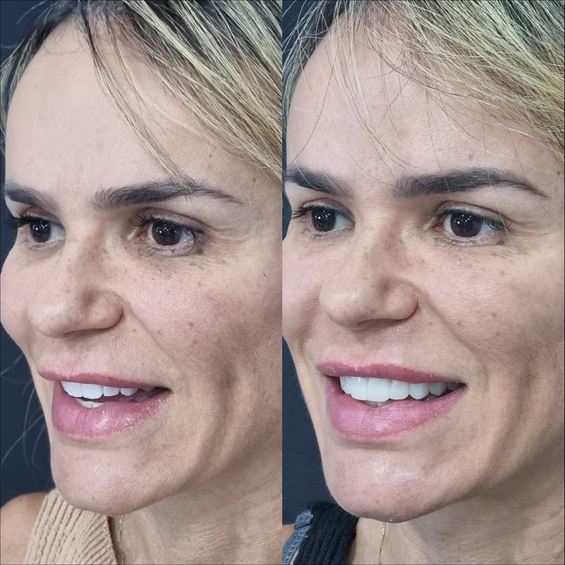 Antes e depois — harmonização do sorriso