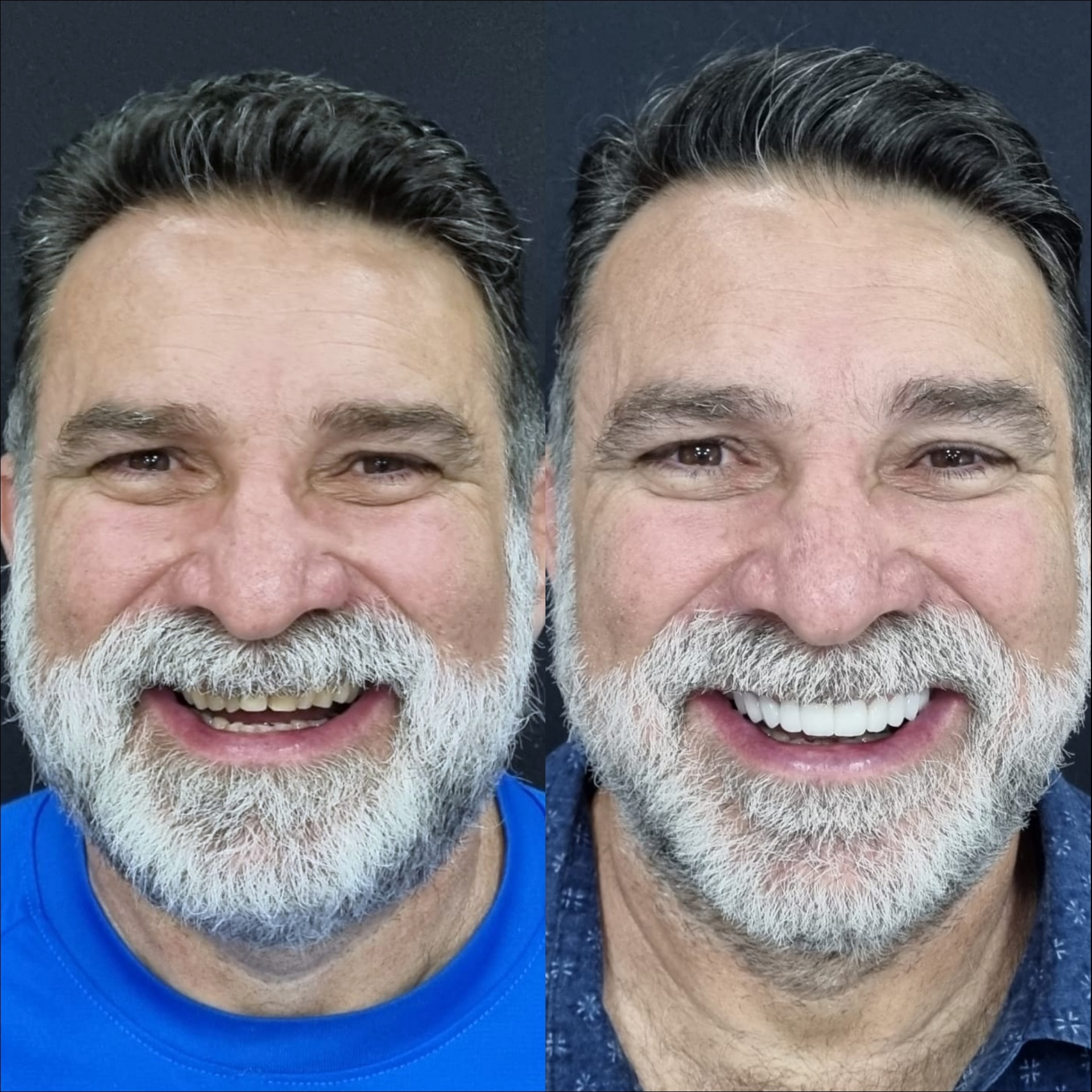 Antes e depois — reabilitação total