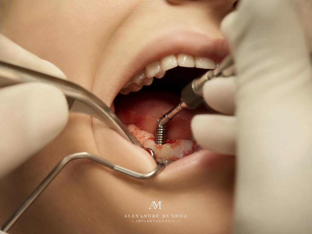 Implantes Dentários