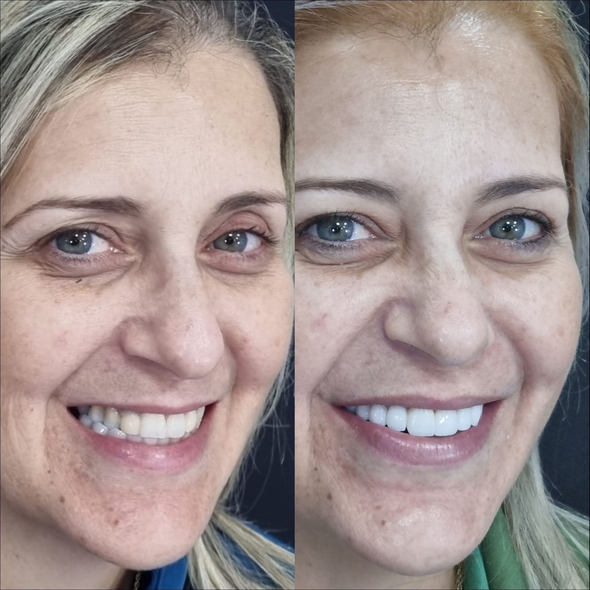 Antes e depois — sorriso harmônico