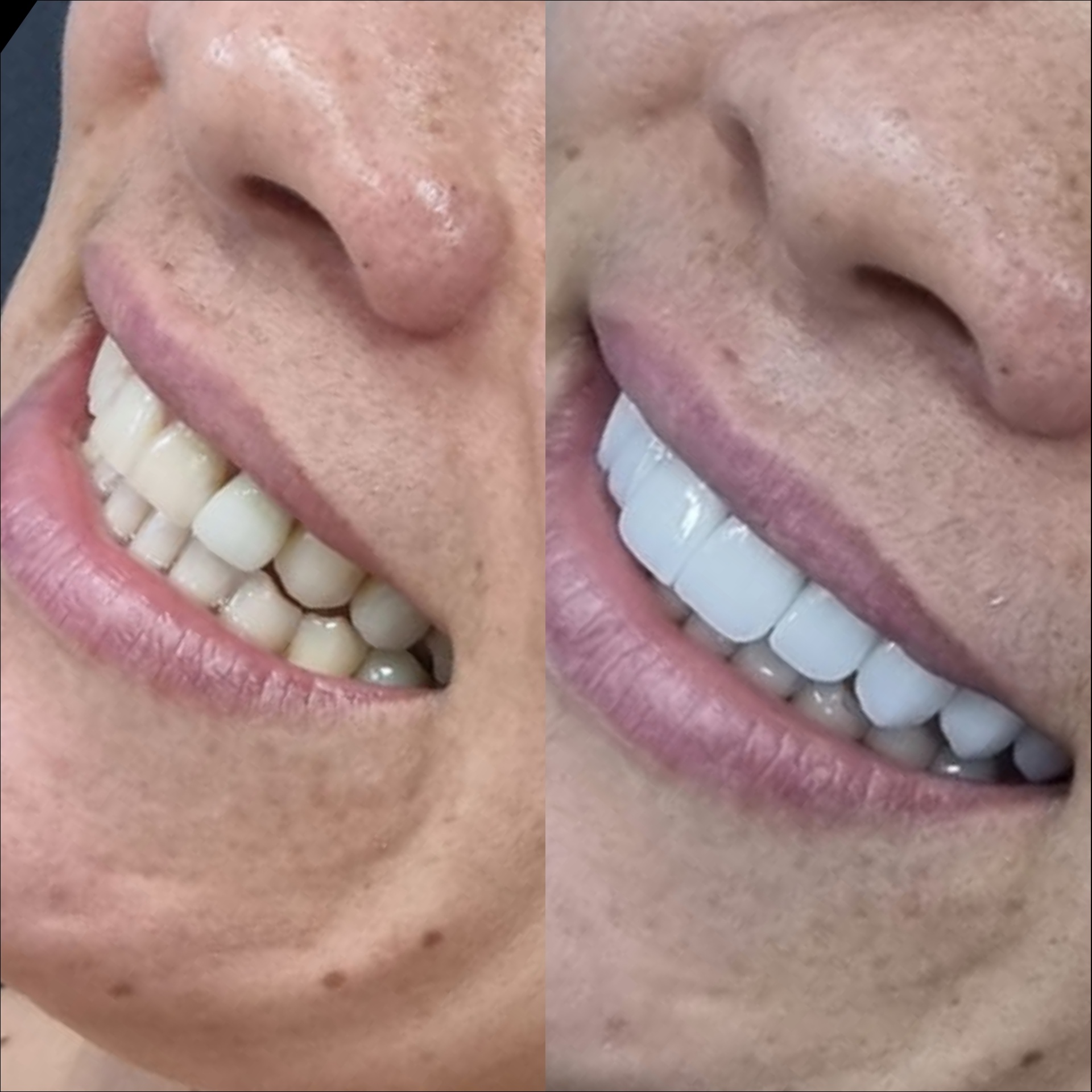 Antes e depois — detalhe de lentes