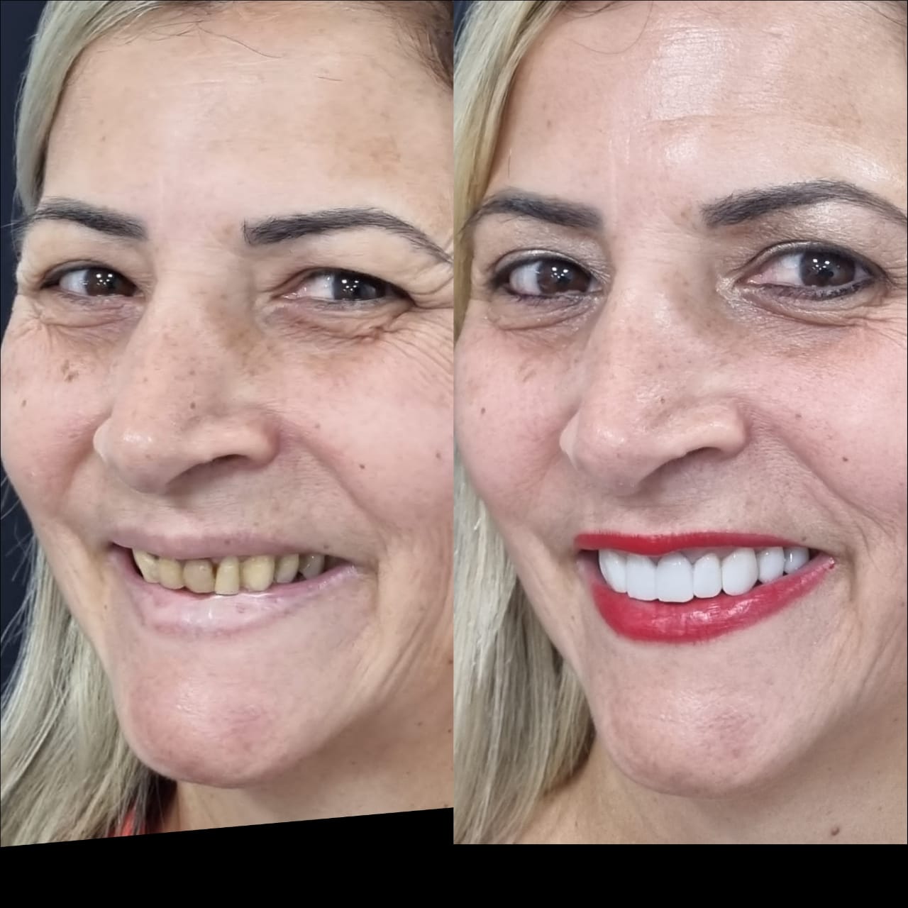 Antes e depois — reabilitação oral completa