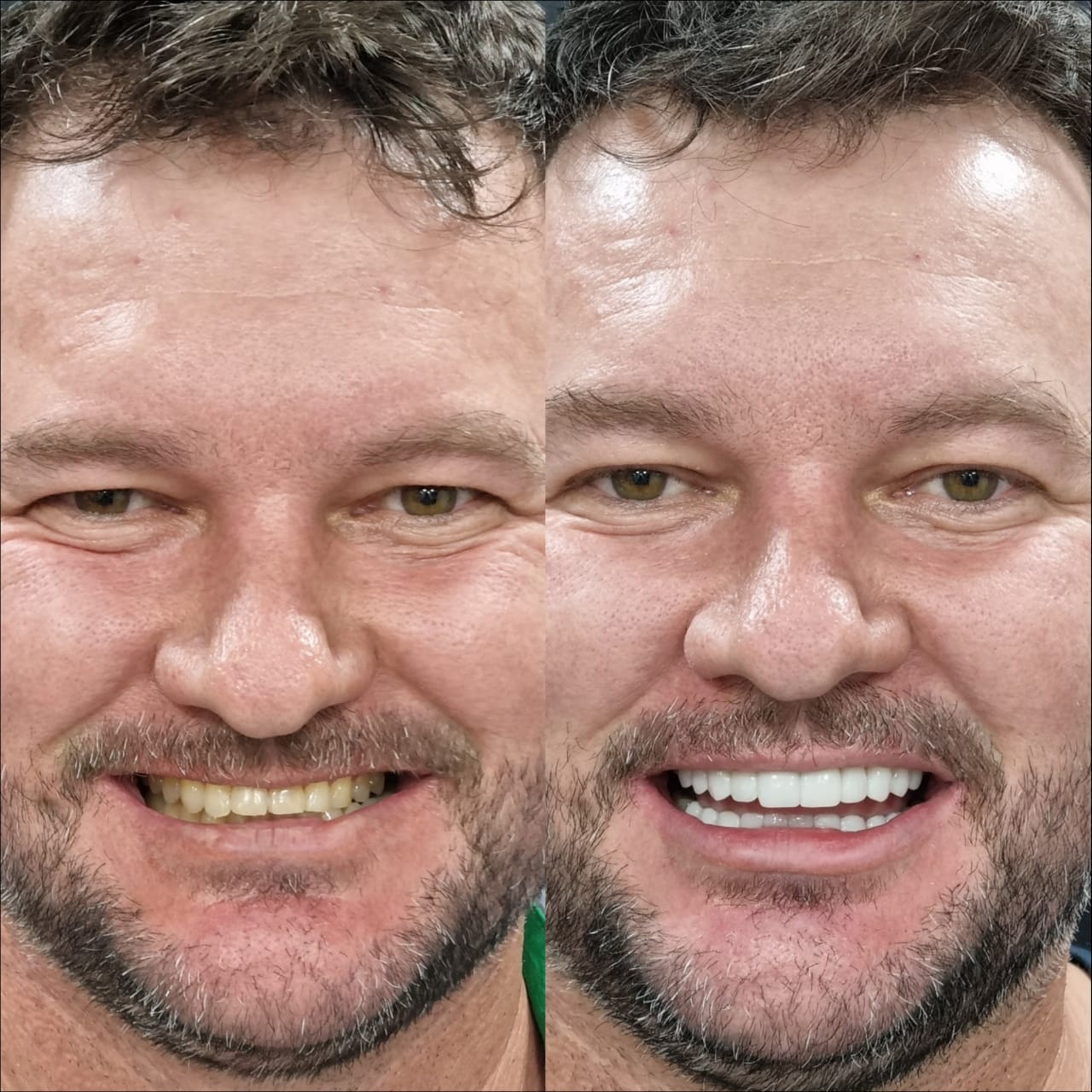 Antes e depois — protocolo estético