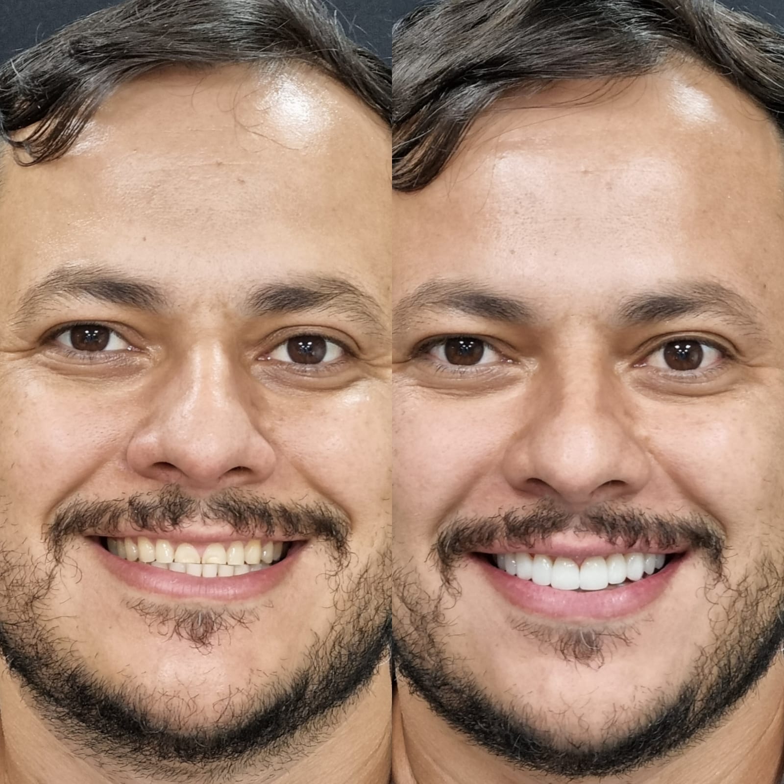 Antes e depois — lentes de porcelana